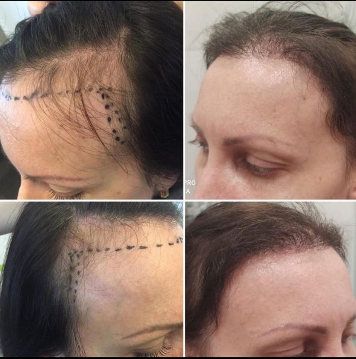 نتائج زراعة الشعر قبل وبعد في عيادة Madame Safiye، استعادة خط الشعر للنساء