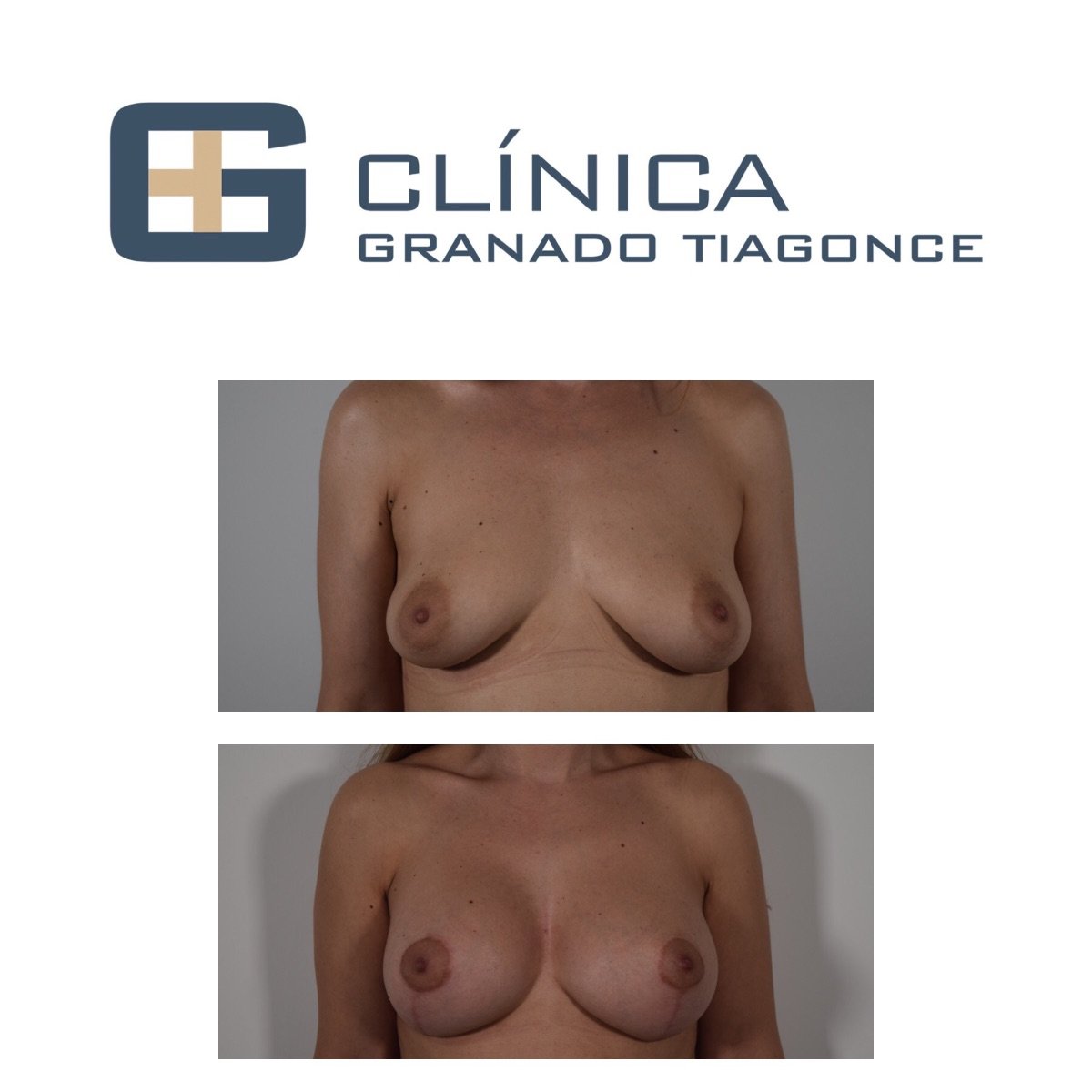 قبل وبعد تكبير ورفع الثدي في Clinica Granado Tiagonce، تحسين شكل الثدي