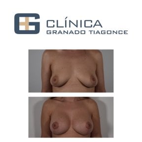 Before and after breast implants with lift at Clinica Granado Tiagonce, enhanced breast shape result