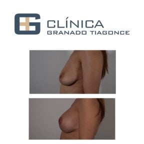 Before and after breast implants with lift at Clinica Granado Tiagonce, enhanced breast shape result