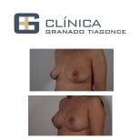 Before and after breast implants with lift results at Clinica Granado Tiagonce, enhanced shape