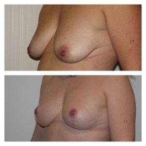 Before and after breast implants with lift at Clinica Granado Tiagonce, enhanced breast shape result