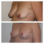 Before and after breast implants with lift at Clinica Granado Tiagonce, enhanced breast shape result