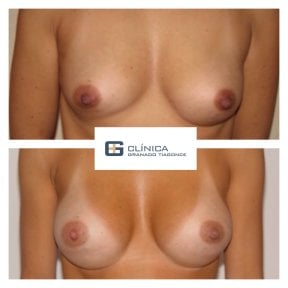 Before and after breast implants with lift at Clinica Granado Tiagonce, enhanced breast shape result
