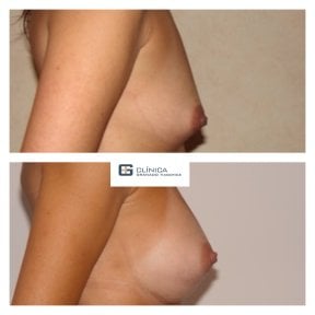 Before and after breast implants with lift at Clinica Granado Tiagonce, enhanced breast shape result