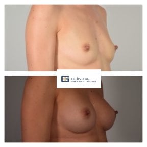 Before and after breast implants with lift at Clinica Granado Tiagonce, enhanced breast shape result