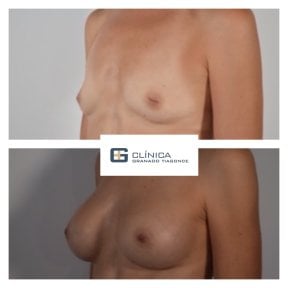 Before and after breast implants with lift at Clinica Granado Tiagonce, enhanced breast shape result