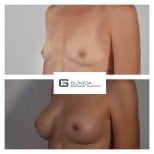 Before and after breast implants with lift at Clinica Granado Tiagonce, enhanced breast shape result