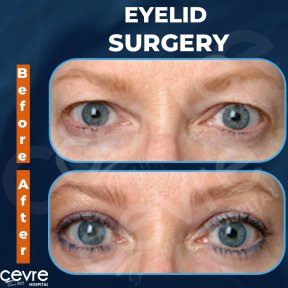 Vorher-nachher-Ergebnisse der Blepharoplastik bei Adem and Havva Medical Center, Lidkorrektur