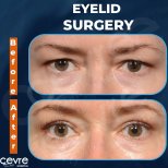 Vorher-nachher-Ergebnisse der Blepharoplastik bei Adem and Havva Medical Center, Lidkorrektur