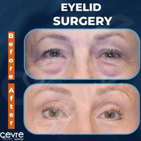 Vorher-nachher-Ergebnisse der Blepharoplastik bei Adem and Havva Medical Center, Lidkorrektur