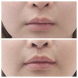 Résultats avant/après lifting des lèvres chez Dr. Tak Plastic Surgery, contour amélioré