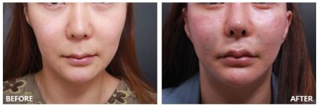 Deep Plane Facelift Vorher-Nachher-Ergebnis bei VG Plastic Surgery, sichtbare Konturveränderung