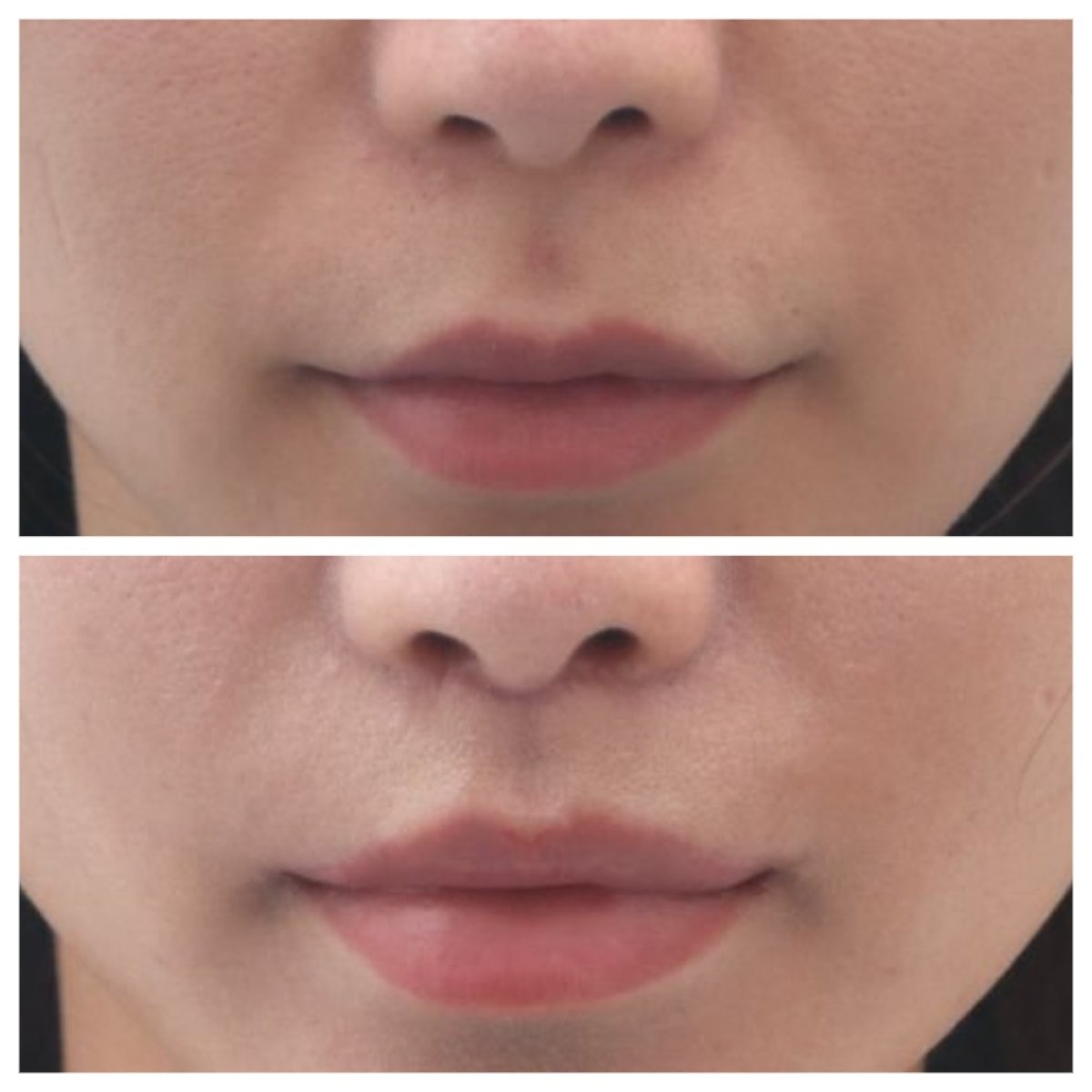 Результаты до и после лип лифтинга в Dr. Tak Plastic Surgery, улучшенный контур губ