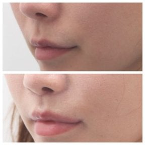Vorher-nachher-Ergebnis Lip Lift bei Dr. Tak Plastic Surgery, verbesserte Lippenkontur
