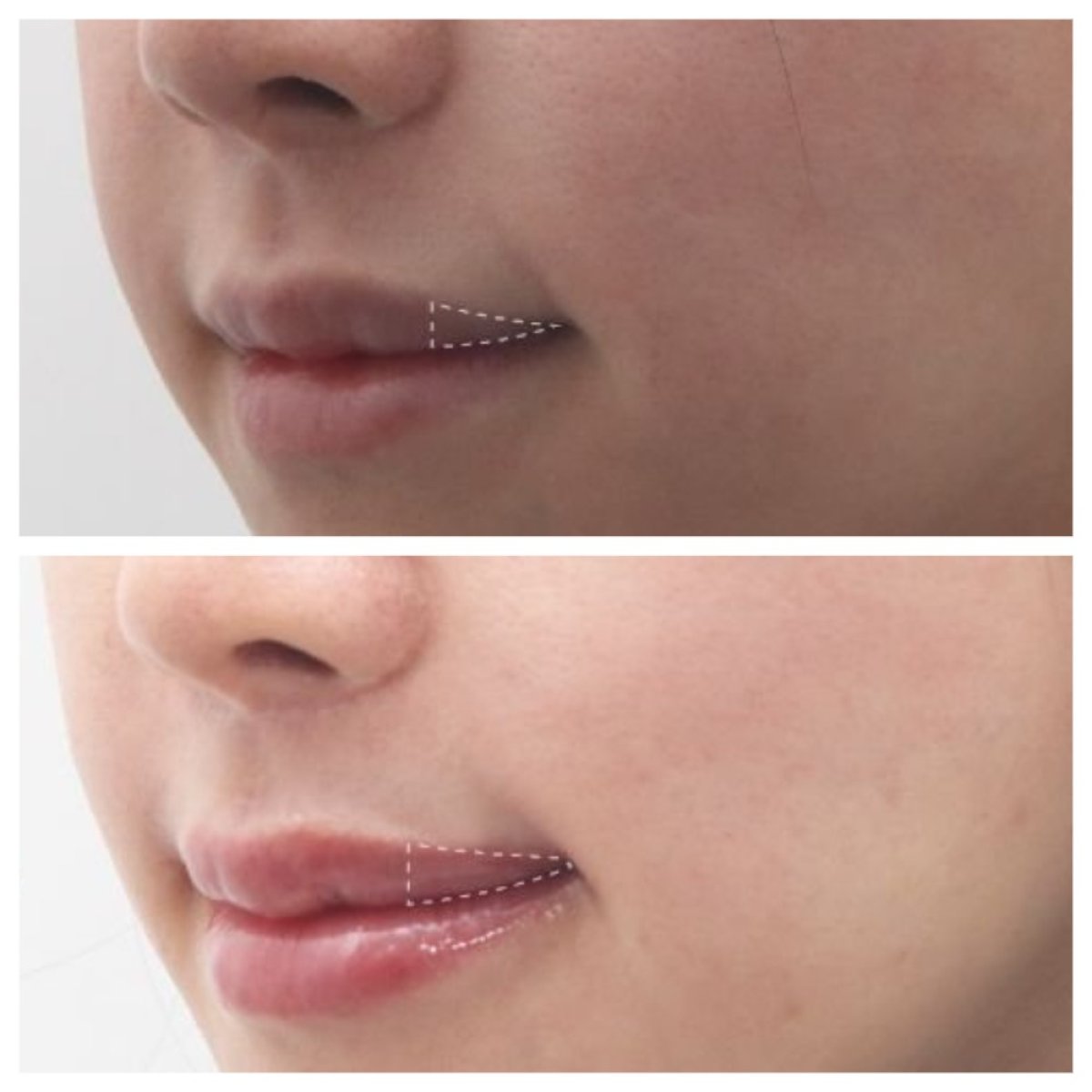 Результаты до и после лип лифтинга в Dr. Tak Plastic Surgery, улучшенный контур губ