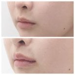 Vorher-nachher-Ergebnis Lip Lift bei Dr. Tak Plastic Surgery, verbesserte Lippenkontur
