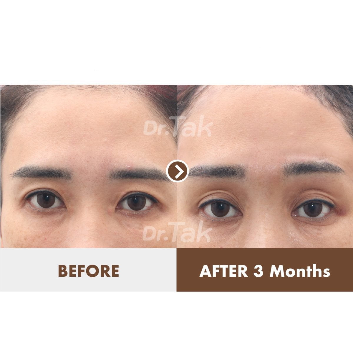 نتائج شد الجبهة قبل وبعد في عيادة Dr. Tak Plastic Surgery، جبين أكثر نعومة بعد 3 أشهر