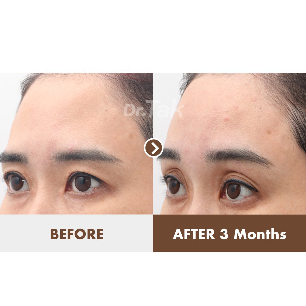 Resultados de lifting de frente antes y después en Dr. Tak Plastic Surgery, elevación visible