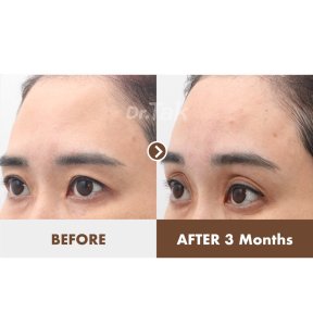 Efekty liftingu czoła przed i po w Dr. Tak Plastic Surgery, widoczne uniesienie brwi