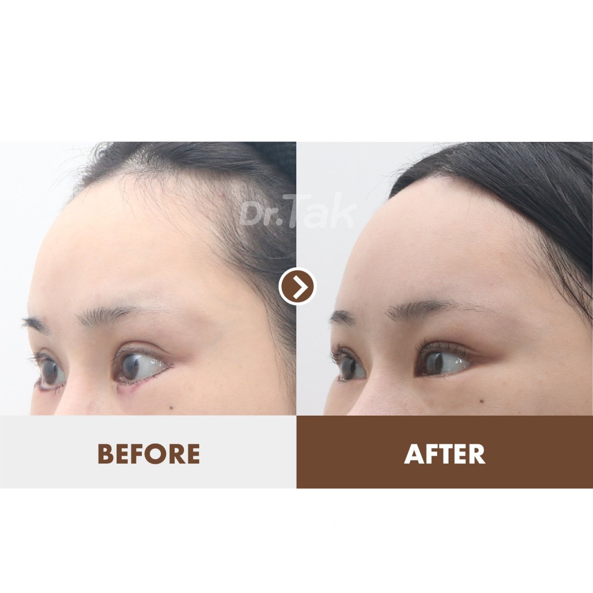 Forehead lift before and after results at Dr. Tak Plastic Surgery, smoother forehead contour
