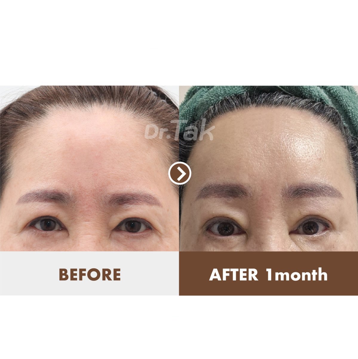 Forehead lift before and after results at Dr. Tak Plastic Surgery, smoother forehead after 1 month