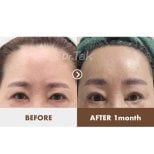 Forehead lift before and after results at Dr. Tak Plastic Surgery, smoother forehead after 1 month