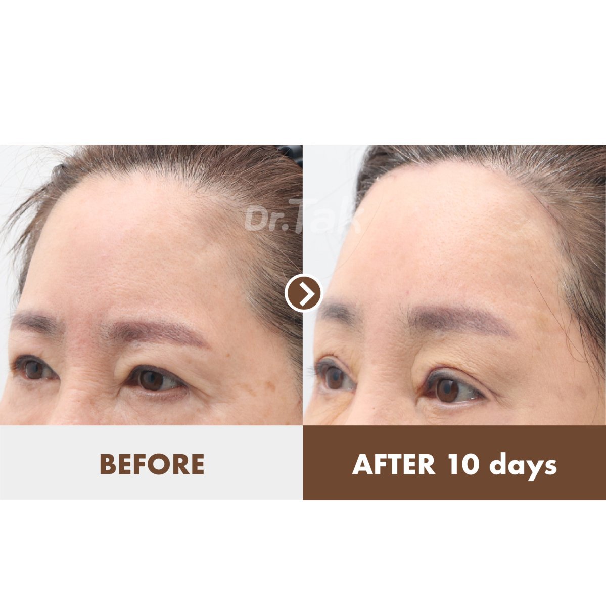 Forehead lift before and after results at Dr. Tak Plastic Surgery, visible brow elevation