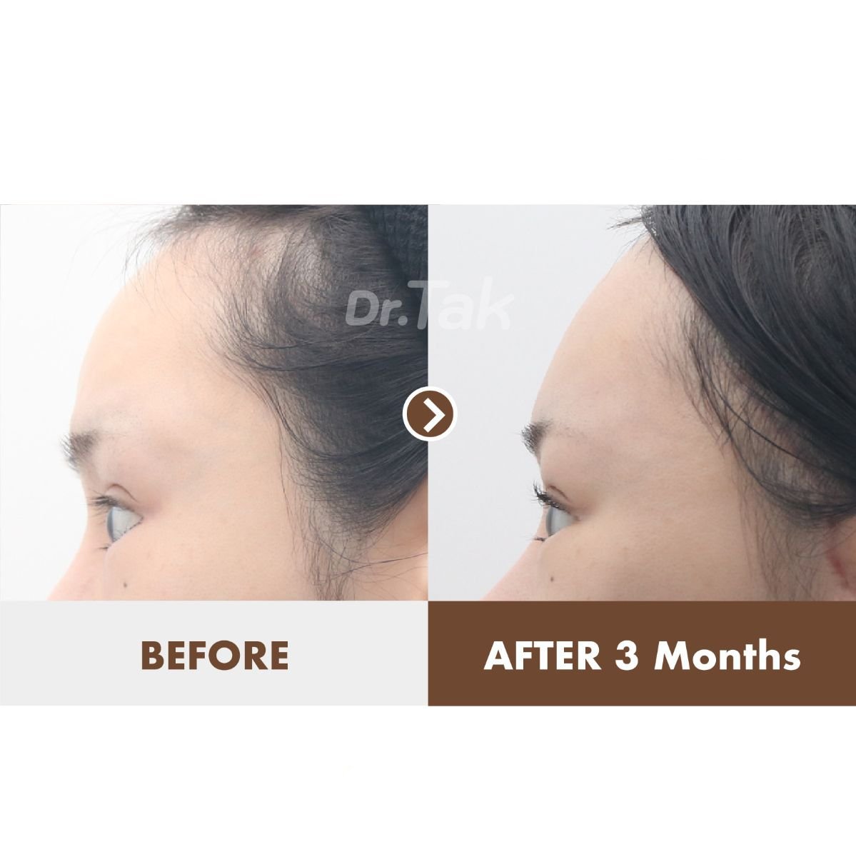 Forehead lift before and after results at Dr. Tak Plastic Surgery, improved hairline in 3 months