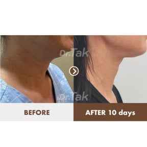 Resultados de lifting de cuello antes y después en Dr. Tak Plastic Surgery, mejora visible