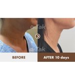 Resultados de lifting de cuello antes y después en Dr. Tak Plastic Surgery, mejora visible