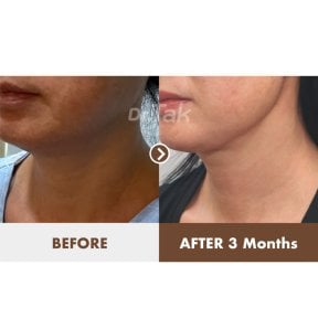 Resultados de lifting de cuello antes y después en Dr. Tak Plastic Surgery, mejora mandibular