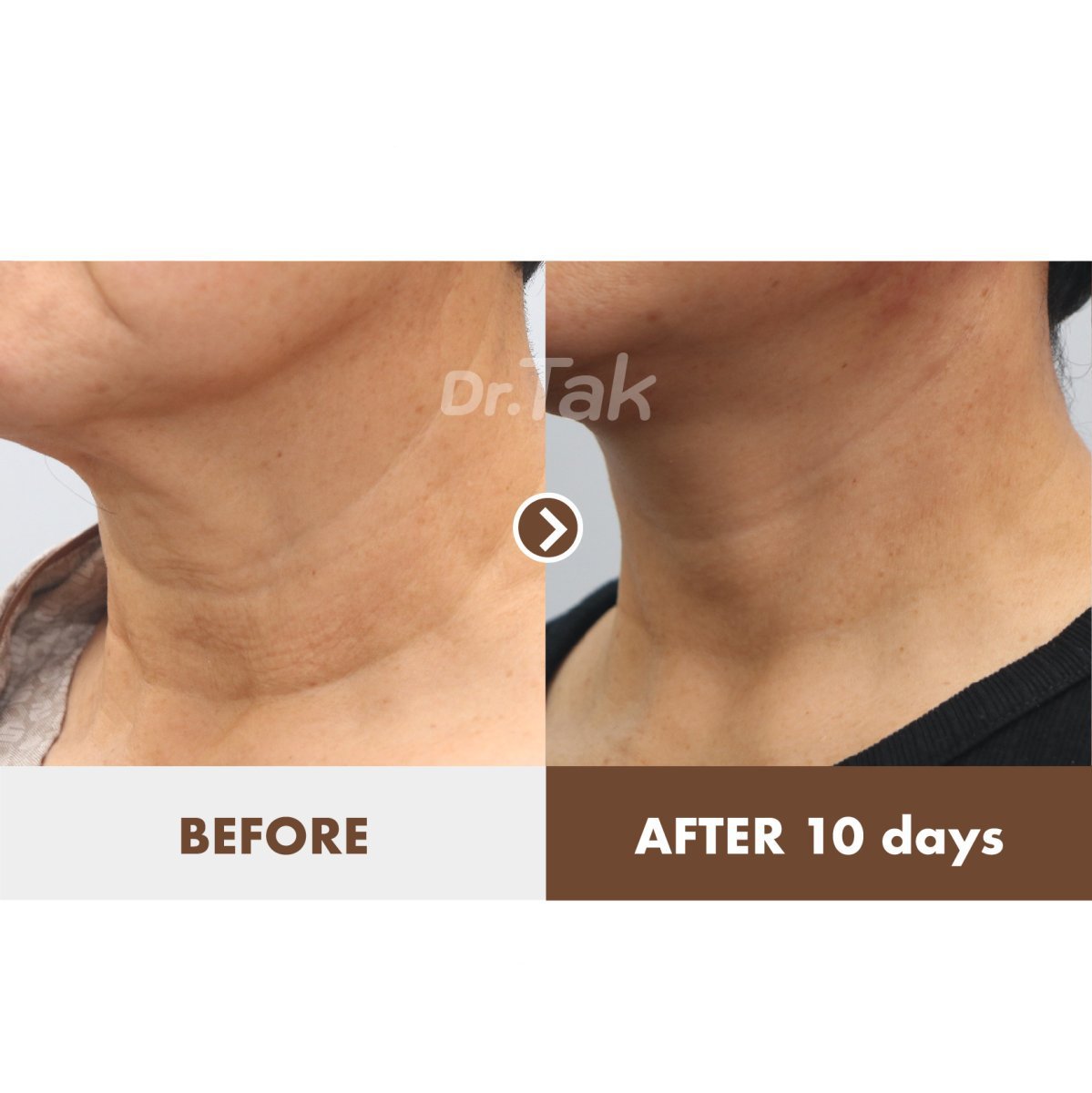 Résultats lifting du cou avant/après chez Dr. Tak Plastic Surgery, peau visiblement raffermie