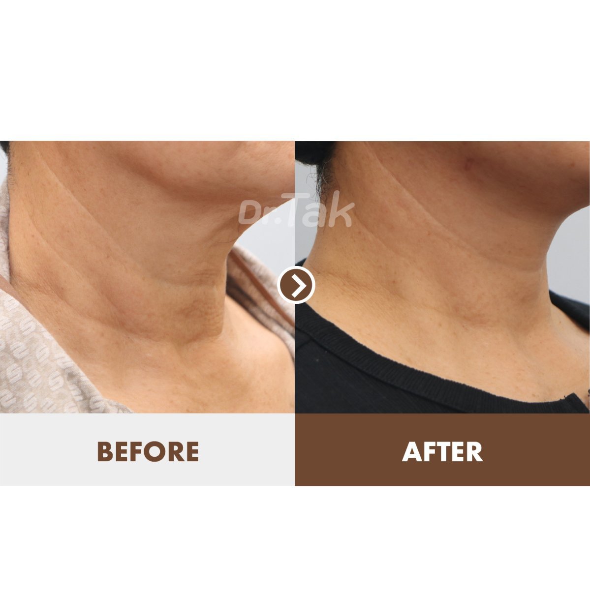 Résultats lifting du cou avant/après chez Dr. Tak Plastic Surgery, cou visiblement raffermi