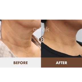 Resultados de lifting de cuello antes y después en Dr. Tak Plastic Surgery, cuello más firme