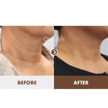 Resultados de lifting de cuello antes y después en Dr. Tak Plastic Surgery, cuello más firme
