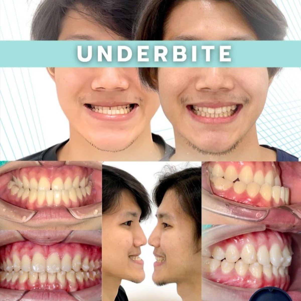 تصحيح العضة السفلية قبل وبعد بالتقويم الشفاف في SmileBox Dental Clinic Thonglor النتيجة