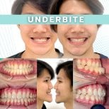 Underbite correction before and after with clear aligners at SmileBox Dental Clinic Thonglor result
