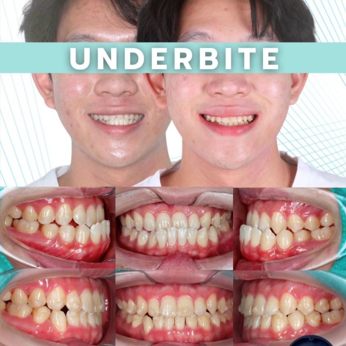 تصحيح العضة السفلية بتقويم شفاف قبل وبعد في SmileBox Dental Clinic - Thonglor