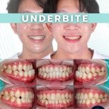 Underbite correction with clear aligners before and after results at SmileBox Dental Clinic - Thonglor