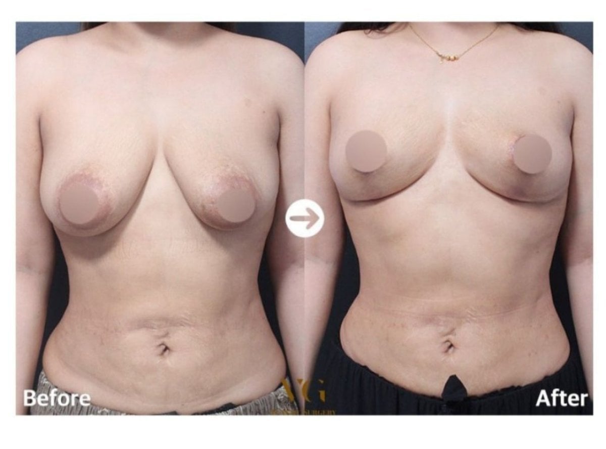 نتائج شد الثدي قبل وبعد في VG Plastic Surgery – تحسين شكل وتناسق الثدي