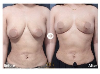 Результаты до и после подтяжки груди в VG Plastic Surgery – улучшенная форма груди