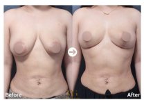 Результаты до и после подтяжки груди в VG Plastic Surgery – улучшенная форма груди