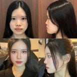 Результаты до и после закрытой ринопластики в VG Plastic Surgery, улучшение формы носа