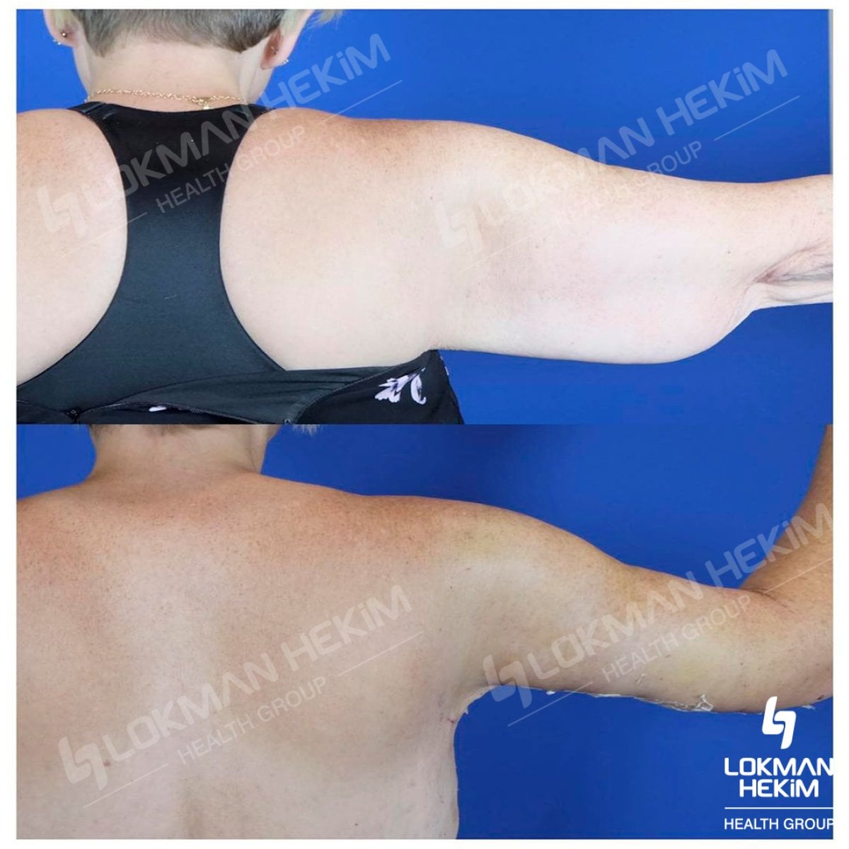 Resultados antes y después de lifting de brazos en Lokman Hekim Istanbul Hospital, brazos firmes