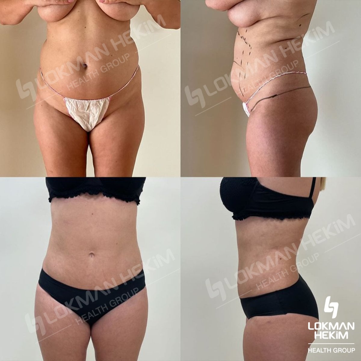 Resultados de liposucción 360 antes y después en Lokman Hekim Istanbul Hospital, contorno corporal