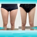 Before and after thigh lift results at Wansiri Hospital, slimmer thighs after 7 days