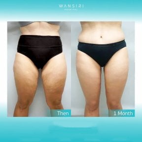 Before and after thigh lift results at Wansiri Hospital – improved thigh contour in 1 month