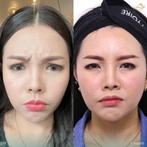 Before and after preventative botox results at Anjali Clinic, reduced forehead wrinkles