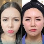 Before and after preventative botox results at Anjali Clinic, reduced forehead wrinkles
